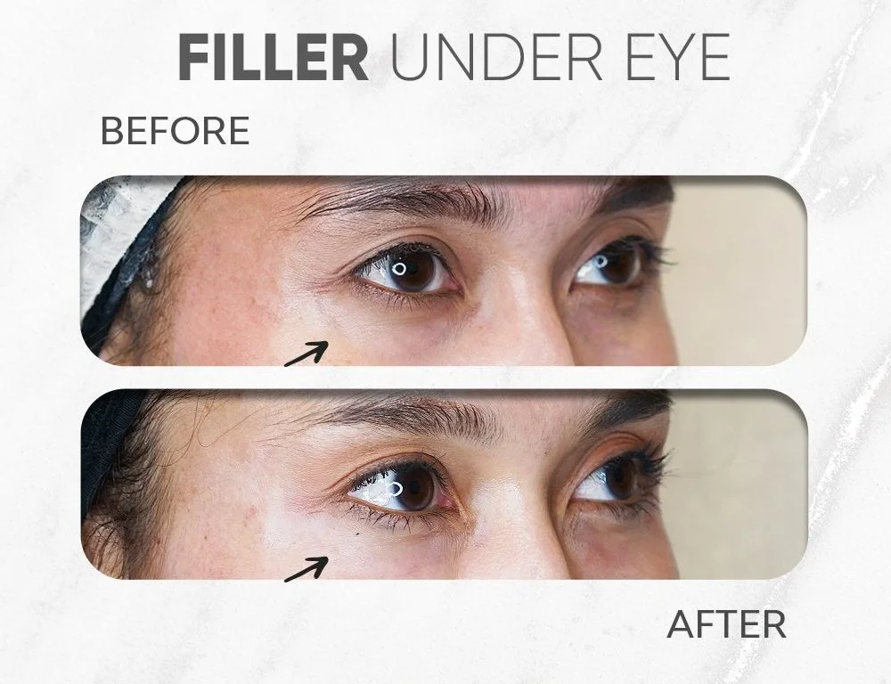 filler kantung mata natural