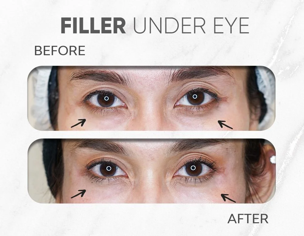 SkinEvo filler kantung mata