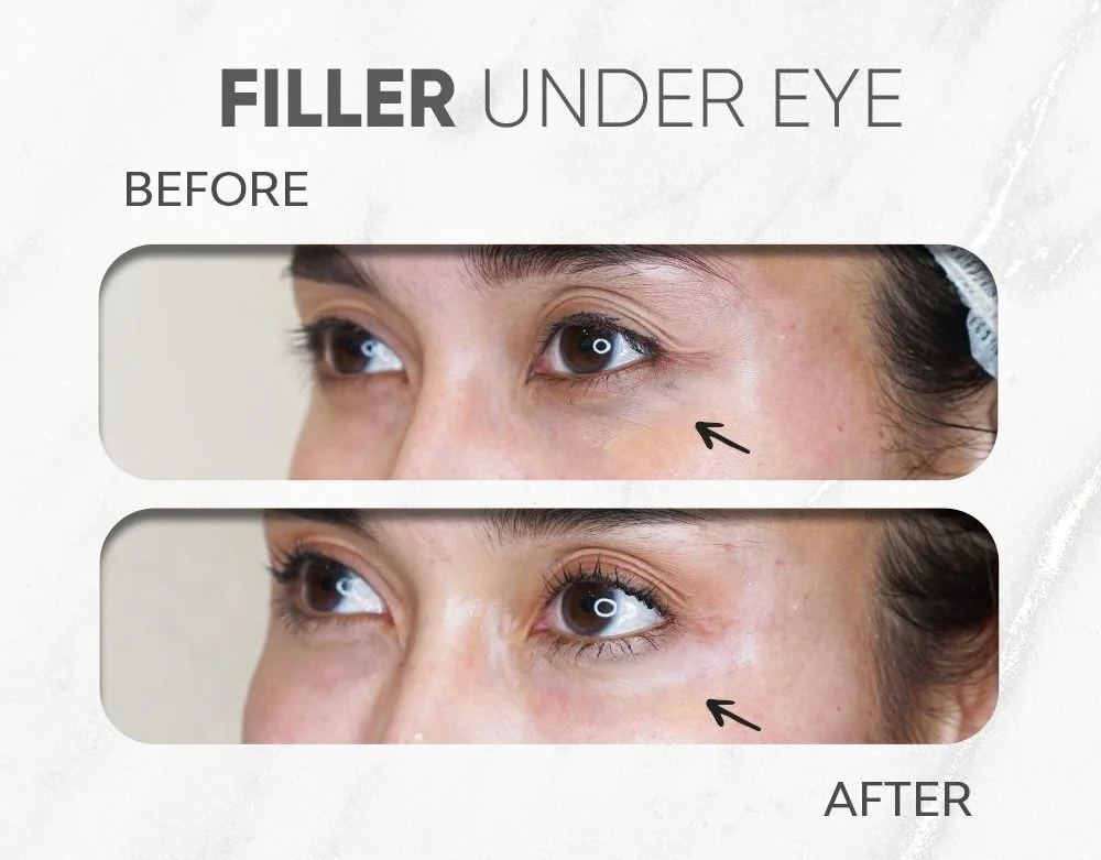 filler kantung mata instan